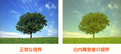 【続】白内障